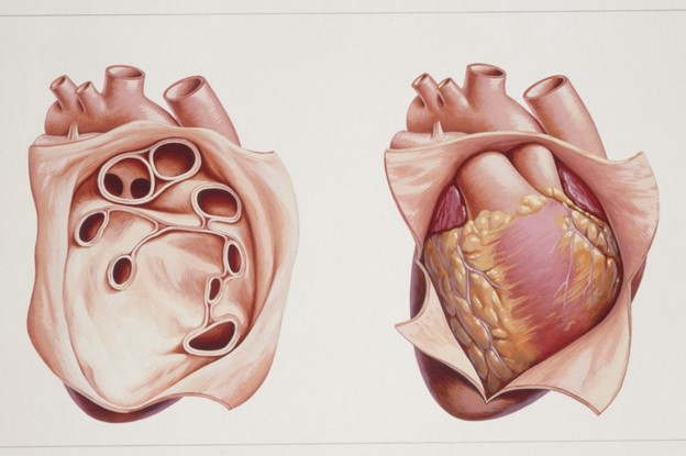 بیماری های جداره خارجی قلب (پریکارد)