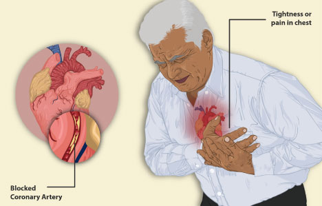 آنژین قلبی ناپایدار یا آنژین صدری ناپایدار ناشی از درد قفسه سینه چیست؟